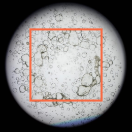 Cholangiocarcinoma_01_04